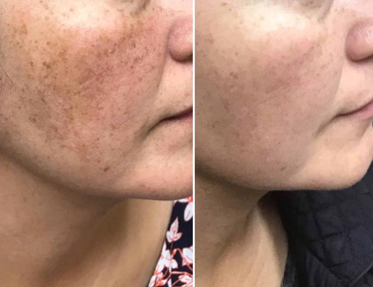 Pico Melasma Treatment Result