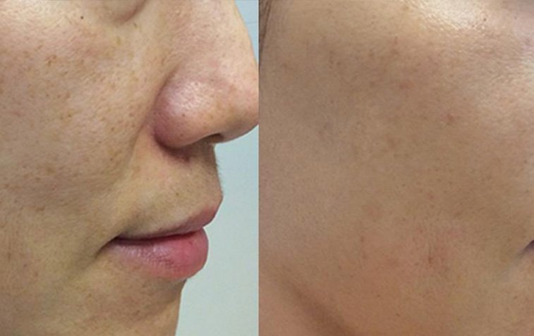 Pico Freckles Removal Result