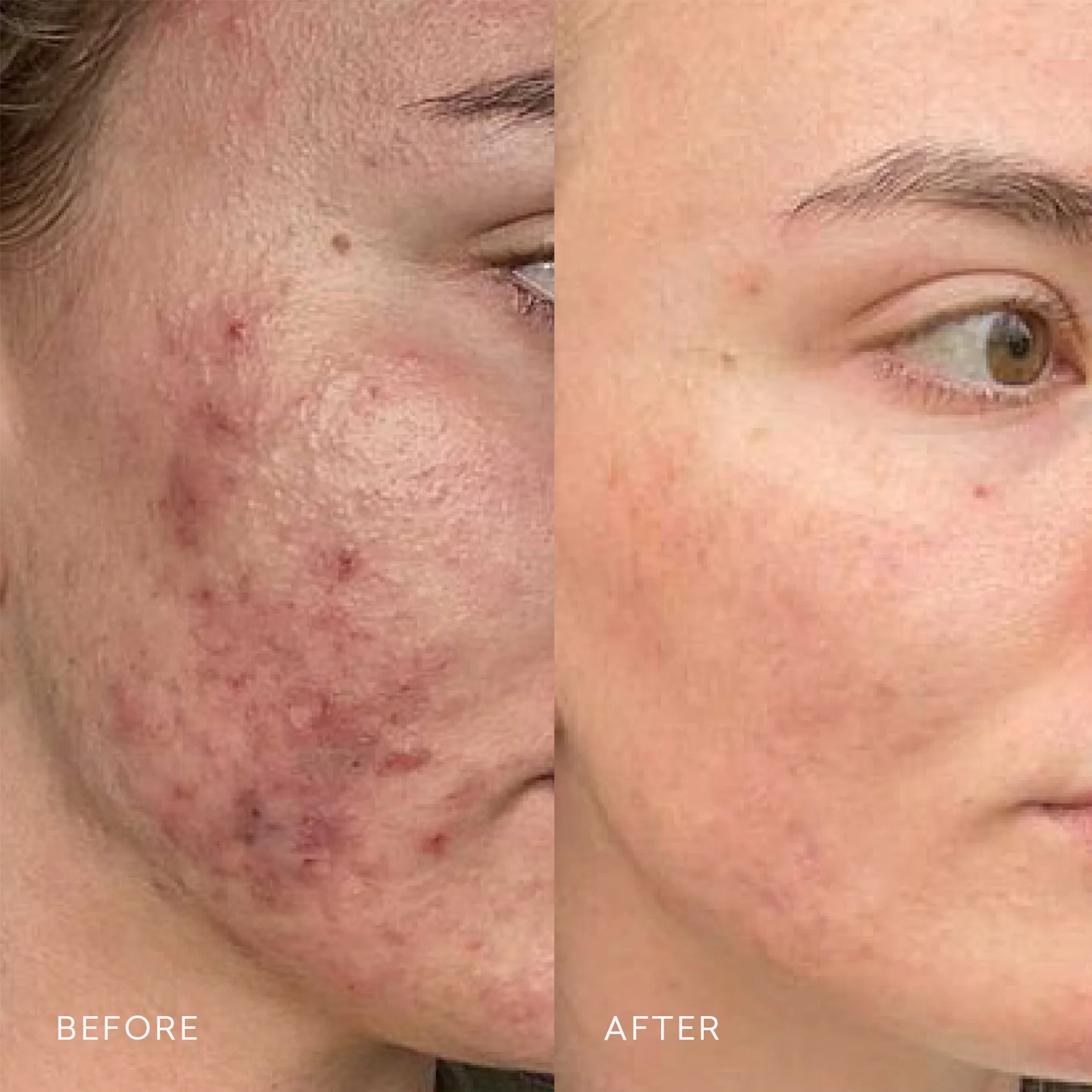 Acne Treatment Before After Result