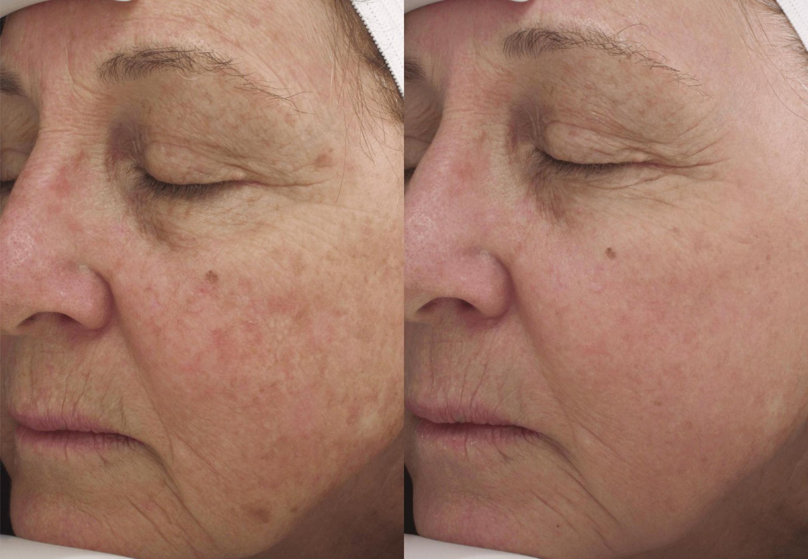 Pico 4 Before After Result