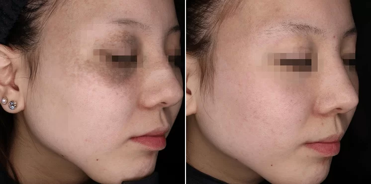 Pigmentation Treatment Result
